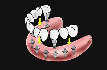 What Should New Dental Implants Cost You? – Search For Affordable Options & Dentist Info