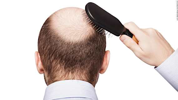 Balding, premature graying tied to higher heart disease risk