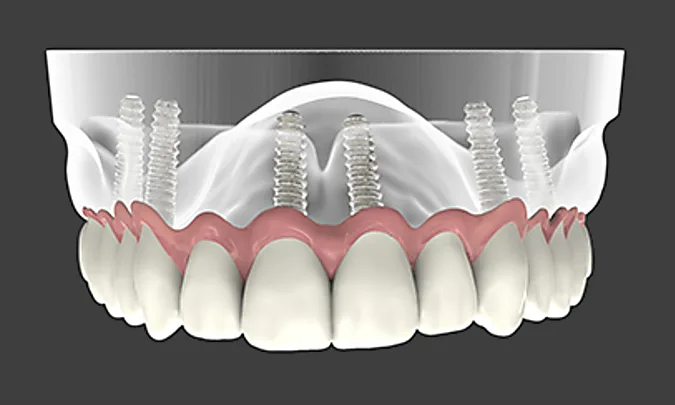 This is What Dental Implants Should Cost in Massachusetts