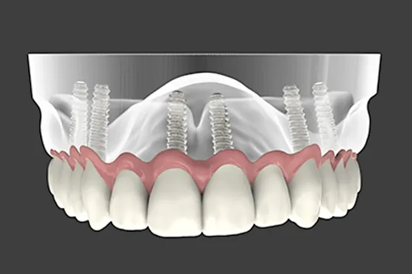 Here's What Dental Implants Should Cost in Rhode Island