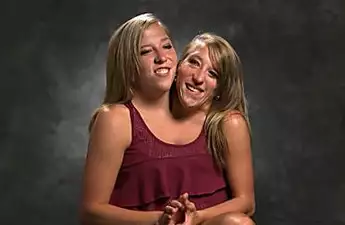 [Pics] 10 Years Ago Conjoined Twins Were Separated. News Crew Catches Up With Them
