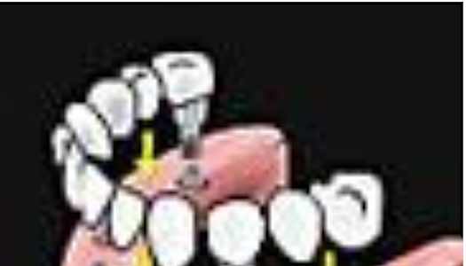 What Should New Dental Implants Cost You? – Search For Affordable Options