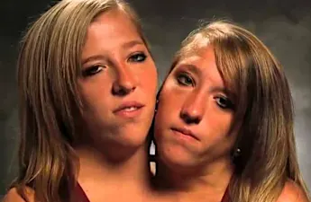 [Photos] Girls Conjoined At Birth Have Made Their Decision: It Will Tear You Apart