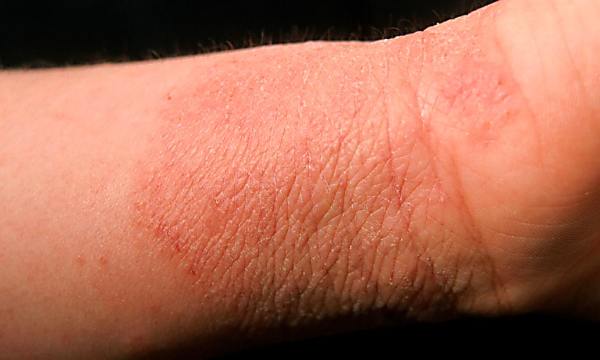 A possible new weapon against eczema: live bacteria