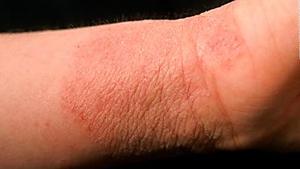 A possible new weapon against eczema: live bacteria