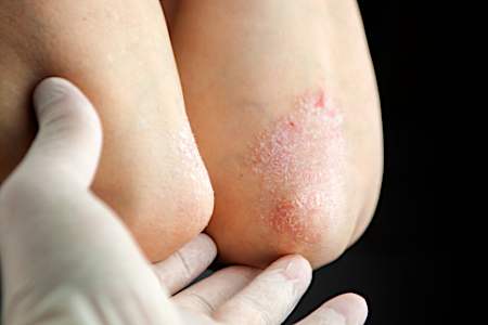 11 Items To Keep Close By If You Have Psoriasis