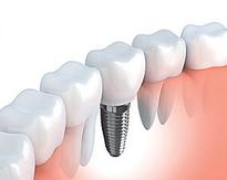 Aquí está lo que los nuevos implantes dentales deben costar