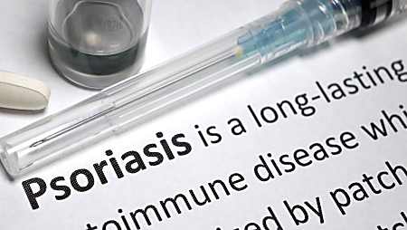 What is Plaque Psoriasis? Signs, Causes & Symptoms