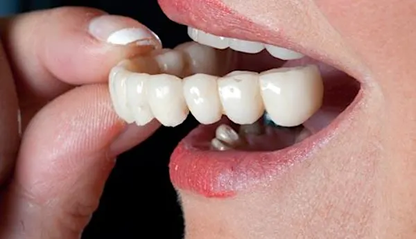 They Look And Feel Like Real Teeth. Here's What They Cost